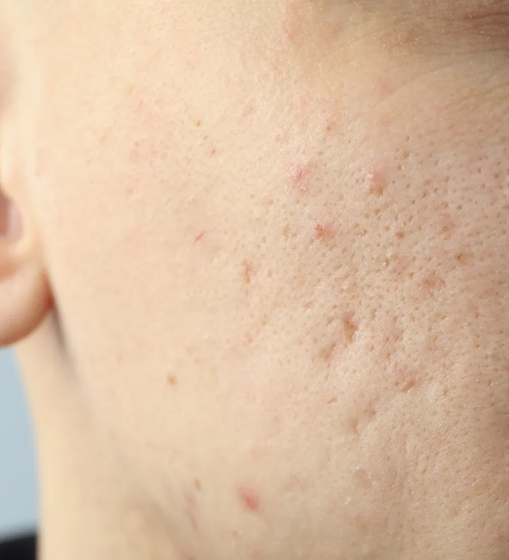 Tratamiento facial para mejorar textura y tono apagado de la piel en HF Derma Clinique, Escazú.